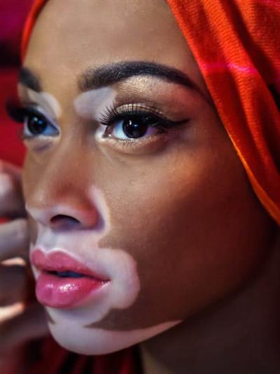 Winnie Harlow